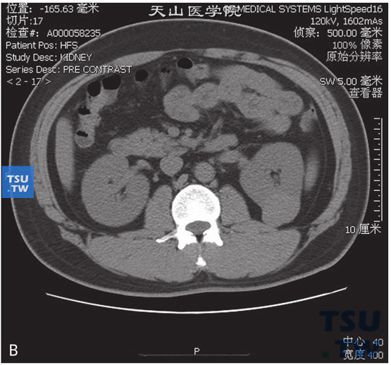 图B：CT，肾平滑肌瘤，男，51岁，体检左肾占位。左肾实质内见一略高密度灶凸出肾轮廓外，边缘清晰，增强后中度强化，皮质期及实质期病灶持续强化