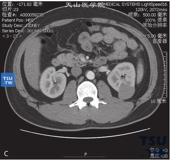 图C：CT，肾平滑肌瘤，男，51岁，体检左肾占位。左肾实质内见一略高密度灶凸出肾轮廓外，边缘清晰，增强后中度强化，皮质期及实质期病灶持续强化