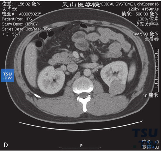图D：CT，肾平滑肌瘤，男，51岁，体检左肾占位。左肾实质内见一略高密度灶凸出肾轮廓外，边缘清晰，增强后中度强化，皮质期及实质期病灶持续强化