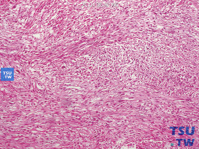 肾平滑肌肉瘤，可见平滑肌束样结构