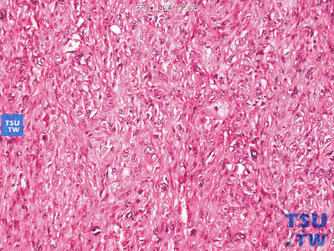 肾平滑肌肉瘤，可见胞质嗜酸的梭形细胞及分化差的多形性细胞