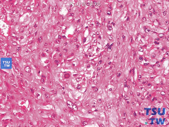 肾平滑肌肉瘤，瘤细胞呈去分化表现，可见核仁显著的异型核及核分裂象