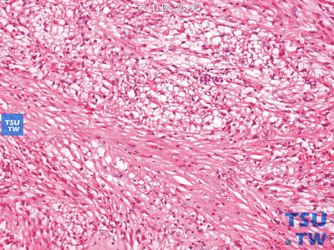 肾平滑肌肉瘤，细胞变性，呈网状结构