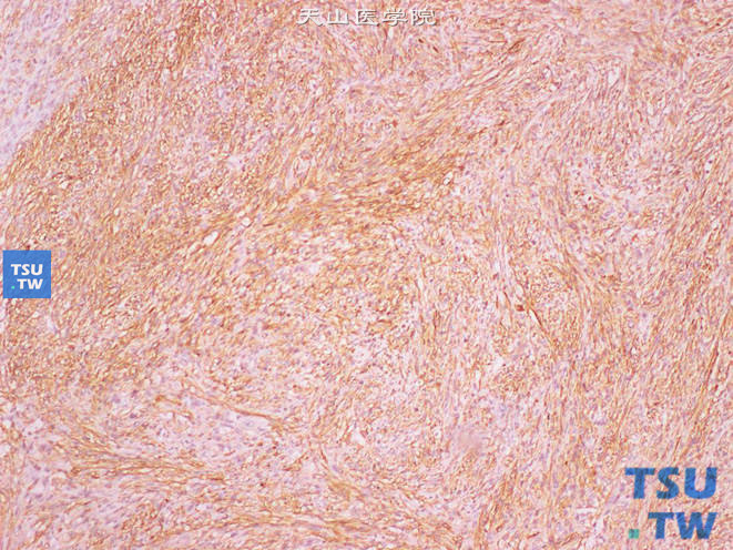 肾平滑肌肉瘤，SMA（+）