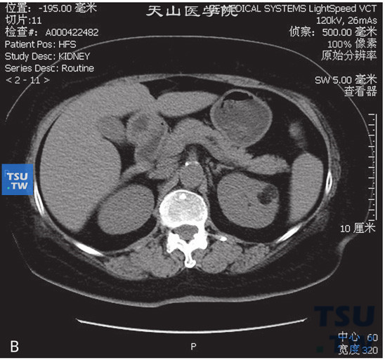 图B：CT，肾脂肪瘤，男，32岁，体检左肾占位。左肾实质内见结节状脂肪密度灶，边缘清晰，其内见少量稍高密度索条，增强扫描索条可见轻度强化，脂肪密度灶未见强化