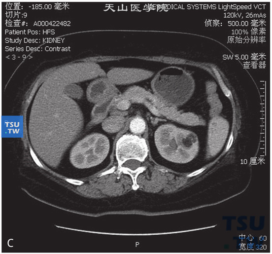 图C：CT，肾脂肪瘤，男，32岁，体检左肾占位。左肾实质内见结节状脂肪密度灶，边缘清晰，其内见少量稍高密度索条，增强扫描索条可见轻度强化，脂肪密度灶未见强化