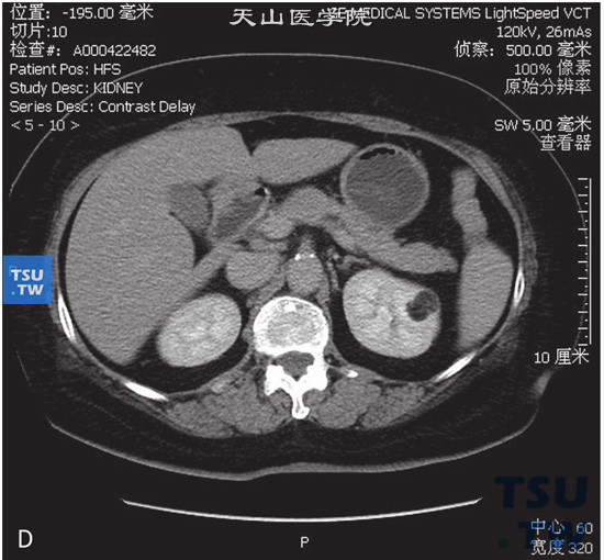图D：CT，肾脂肪瘤，男，32岁，体检左肾占位。左肾实质内见结节状脂肪密度灶，边缘清晰，其内见少量稍高密度索条，增强扫描索条可见轻度强化，脂肪密度灶未见强化