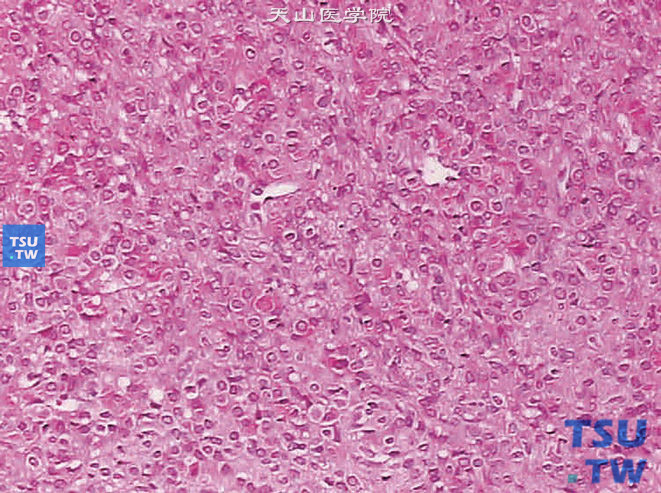 球旁细胞瘤。示肿瘤细胞呈多角形或圆形，边界清楚