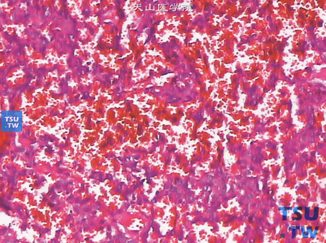 球旁细胞瘤（肾素瘤），示瘤细胞呈不规则条索状排列及间质丰富血窦