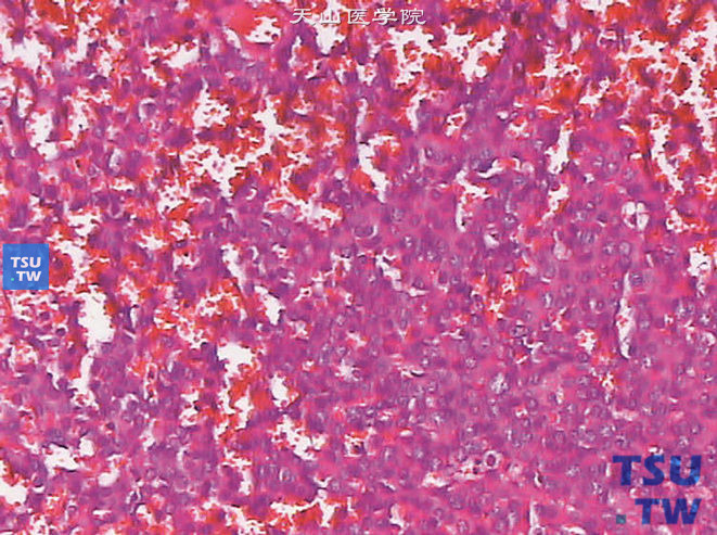 球旁细胞瘤（肾素瘤），示瘤细胞形成小团块及丰富血窦