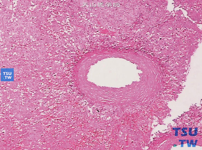 球旁细胞瘤。可见厚壁透明变性的血管