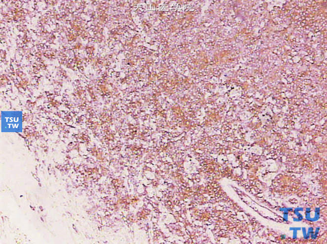 球旁细胞瘤（肾素瘤），免疫组化染色，CD34强阳性