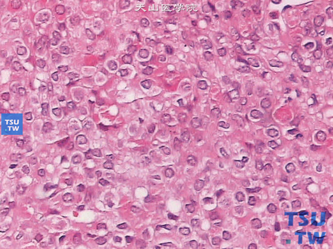 球旁细胞瘤。高倍镜下可见肿瘤细胞具有少量嗜酸性颗粒状胞质。核位于中央，细胞核周围有淡晕