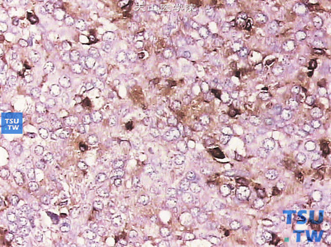 球旁细胞瘤，免疫组化染色，Actin（部分细胞+）