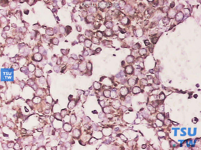 球旁细胞瘤，免疫组化染色，VIM（+）