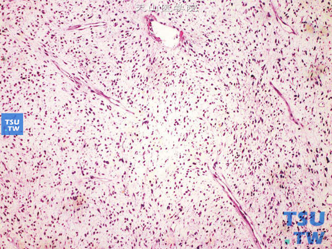 肾旁黏液纤维肉瘤，示纤细的长形薄壁血管