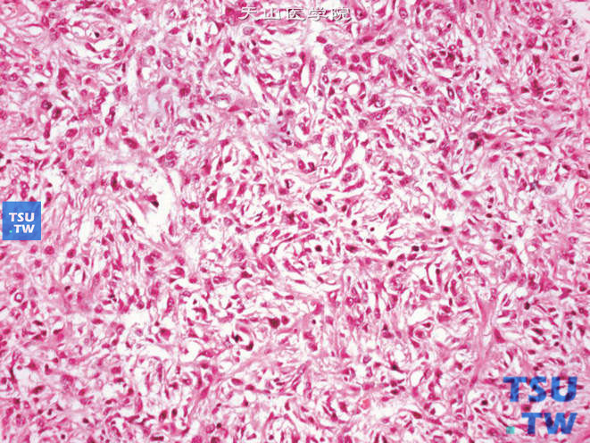 肾旁黏液纤维肉瘤，示细胞密集区核异型，可见核仁