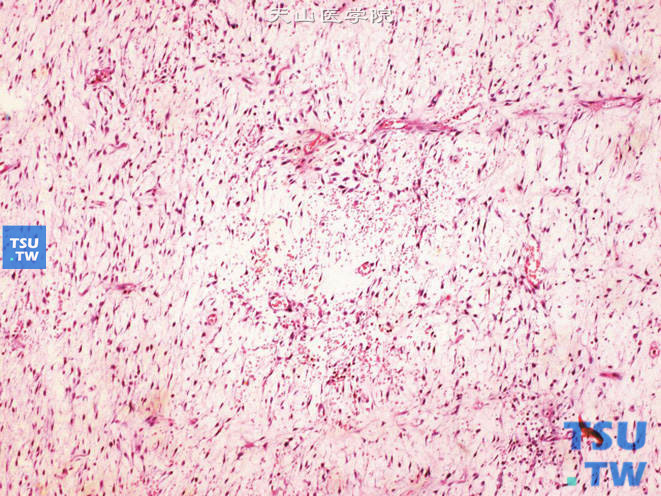 肾旁黏液纤维肉瘤，示血管周围肿瘤细胞密集分布