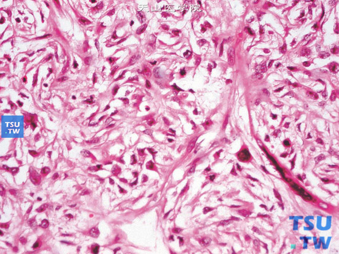 肾旁黏液纤维肉瘤，局部核异型明显，核分裂象多见