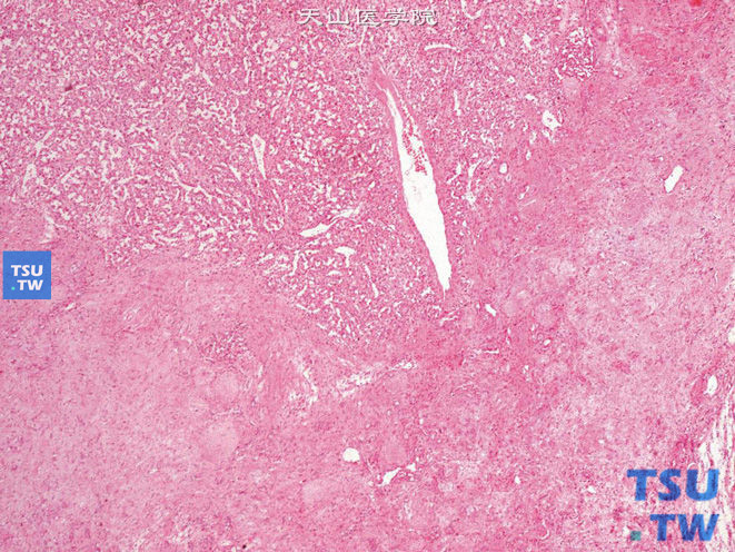 肾血管瘤，肿瘤无包膜，周围肾组织可见明显纤维化