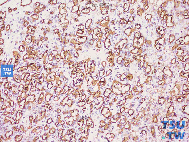 肾低度恶性血管肉瘤，CD34（+）