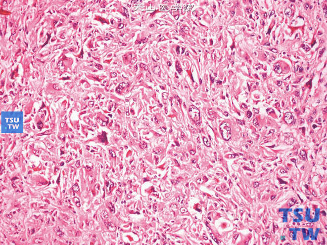 肾窝多形性恶性纤维组织细胞瘤，细胞呈梭形、多角形或圆形结构，可见奇异核
