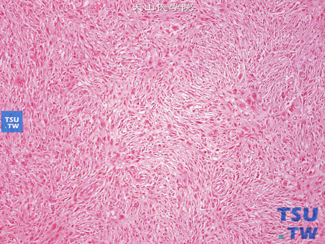 肾窝多形性恶性纤维组织细胞瘤，部分区域呈编席状结构