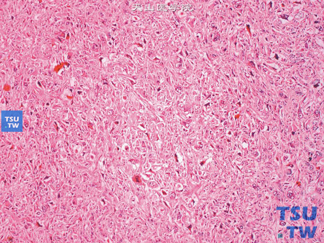 肾窝多形性恶性纤维组织细胞瘤，细胞及细胞核具明显多形性，伴奇异型肿瘤巨细胞，免疫组化未提示特殊分化，呈未分化高级别多形性肉瘤表现