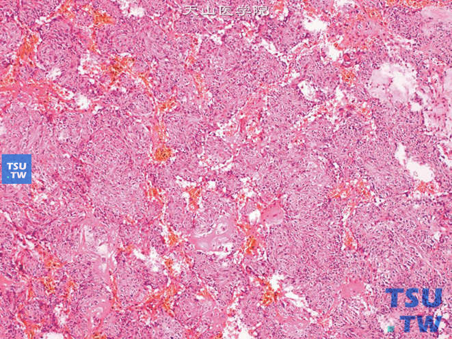 肾血管周细胞瘤（肌性周细胞瘤），示肿瘤间质的薄壁血管