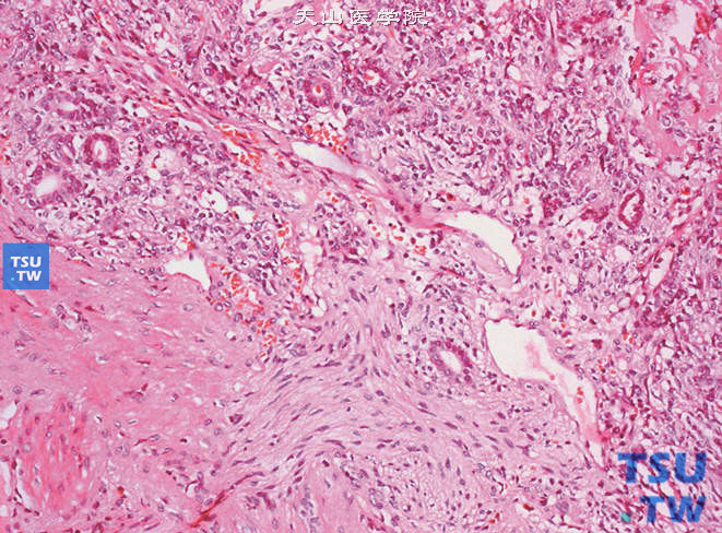 肾血管周细胞瘤（肌性周细胞瘤），此例病变界限欠清，肿瘤边缘可见残存肾小管