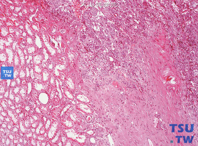 肾血管周细胞瘤（肌性周细胞瘤），此例病变界限欠清，与肾脏交界处结缔组织中可见瘤细胞生长