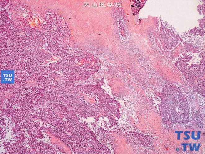 肾PNET，示坏死，残存肿瘤组织围绕于血管周围