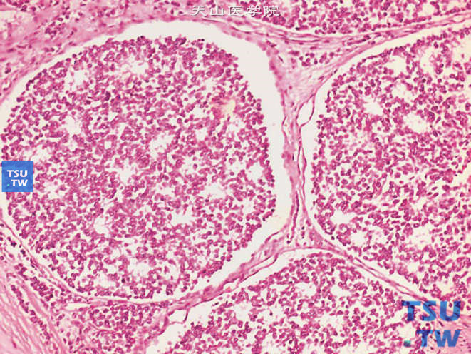 肾PNET，示巢片状菊形团样结构及泡状核
