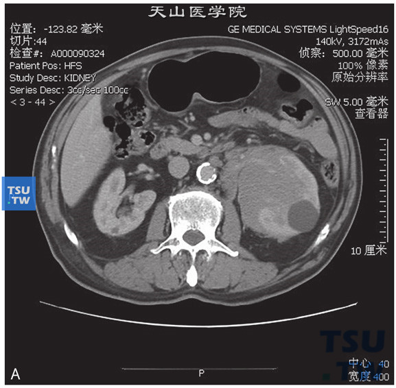 图A：CT，肾淋巴瘤，男，50岁，发现左肾占位。左肾周见软组织密度灶，累及肾实质，包绕肾动静脉，增强后呈轻度强化