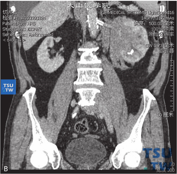 图B：CT，肾淋巴瘤，男，50岁，发现左肾占位。左肾周见软组织密度灶，累及肾实质，包绕肾动静脉，增强后呈轻度强化