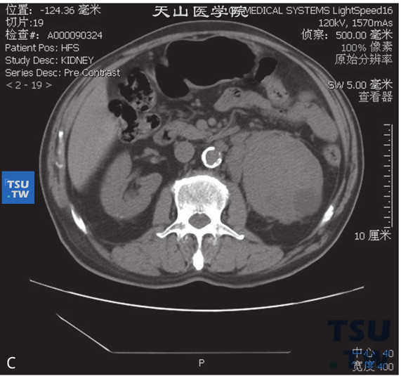 图C：CT，肾淋巴瘤，男，50岁，发现左肾占位。左肾周见软组织密度灶，累及肾实质，包绕肾动静脉，增强后呈轻度强化