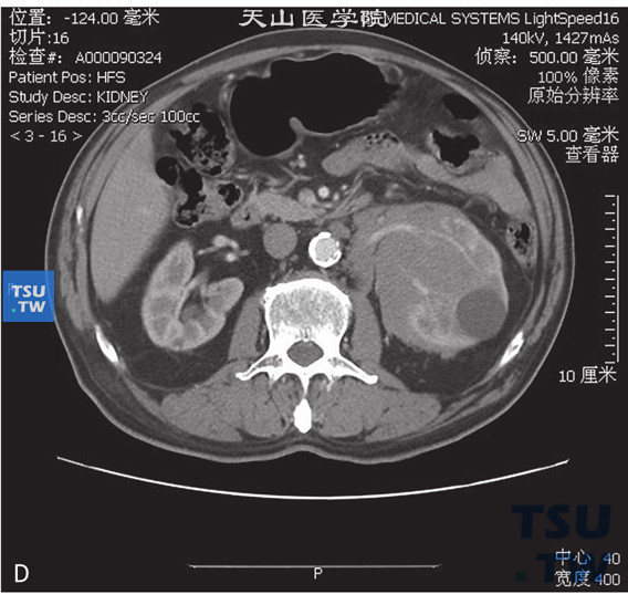 图D：CT，肾淋巴瘤，男，50岁，发现左肾占位。左肾周见软组织密度灶，累及肾实质，包绕肾动静脉，增强后呈轻度强化