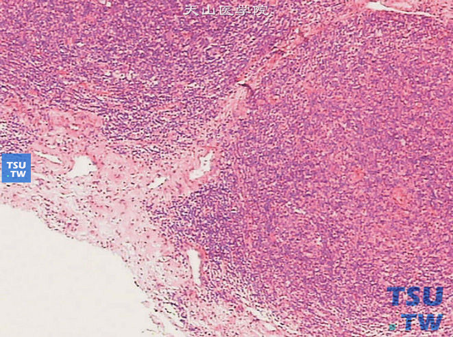 肾被膜下淋巴瘤，瘤细胞为形态一致的非典型淋巴样细胞