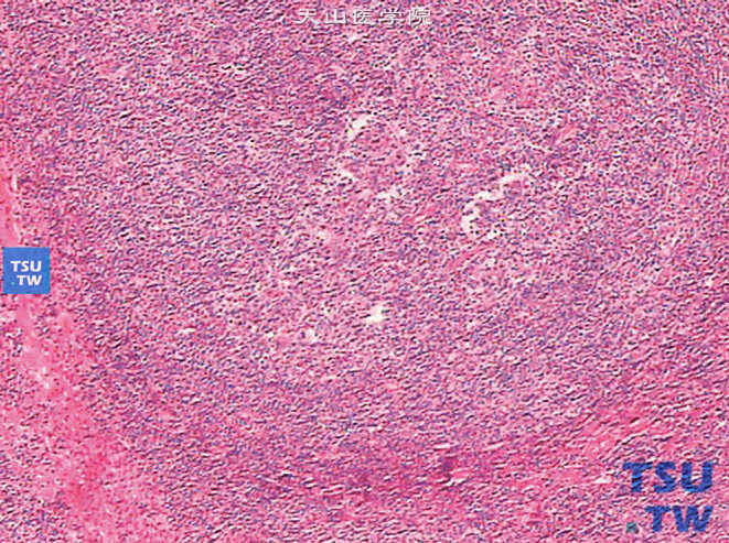 肾被膜下滤泡性淋巴瘤，示滤泡样结构
