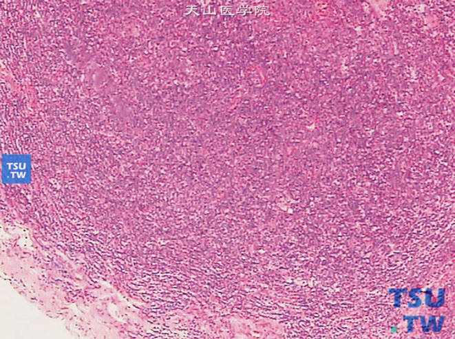 肾被膜下滤泡性淋巴瘤，示瘤细胞从滤泡样结构中外侵