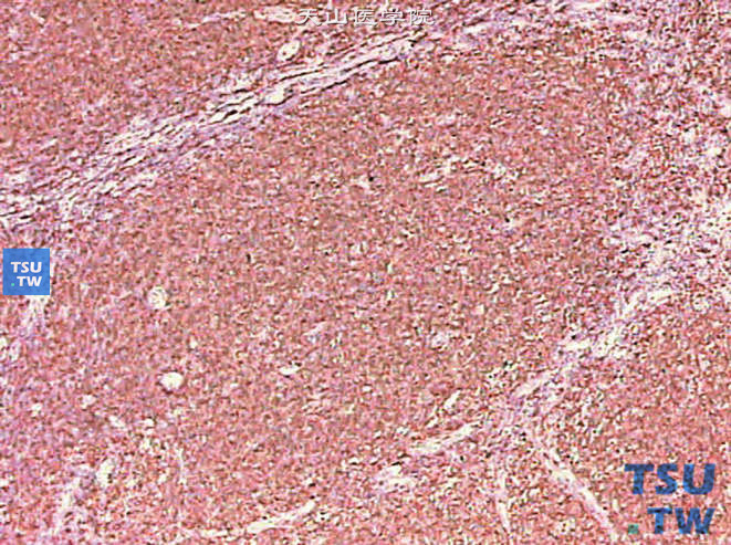 肾被膜下滤泡性淋巴瘤，免疫组化染色，CD20（+）