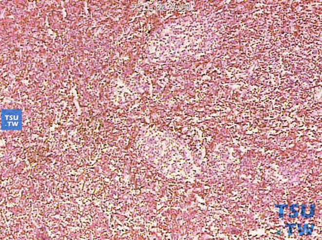 肾被膜下滤泡性淋巴瘤，免疫组化染色，BCL-2（+）