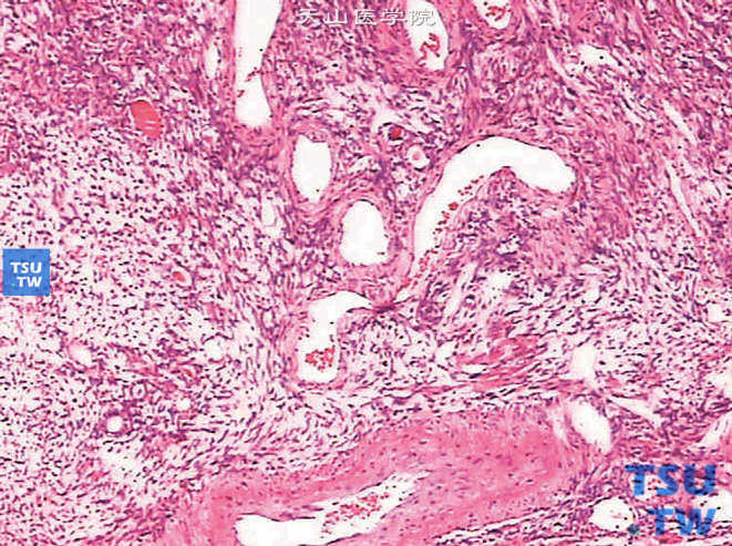 肾畸胎瘤。可见形态不规则的血管结构