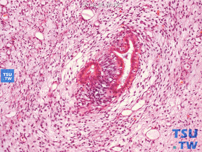 肾畸胎瘤，示幼稚的间叶及管状结构，间质呈漩涡样结构