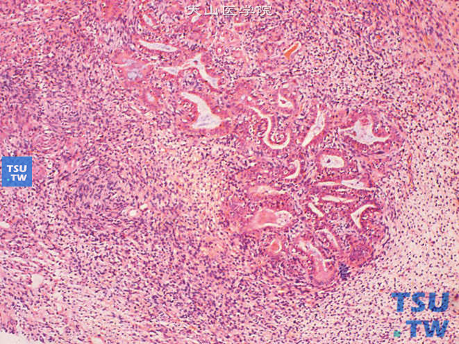 肾畸胎瘤，示幼稚的间叶及管状结构