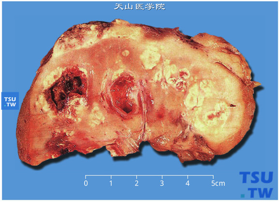 黄色肉芽肿性肾盂肾炎，切面可见慢性、化脓性、脂肪样病灶