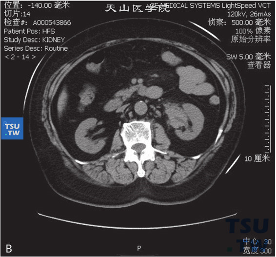 图B：CT，肾炎性假瘤，女，69岁，血尿伴左腰痛。左肾窦内见软组织密度占位，包绕肾盂及肾盂输尿管结合部，外缘毛糙，增强后明显强化。分泌期可见肾盂、肾盏显影，未见明显扩张积水征象