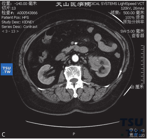 图C：CT，肾炎性假瘤，女，69岁，血尿伴左腰痛。左肾窦内见软组织密度占位，包绕肾盂及肾盂输尿管结合部，外缘毛糙，增强后明显强化。分泌期可见肾盂、肾盏显影，未见明显扩张积水征象