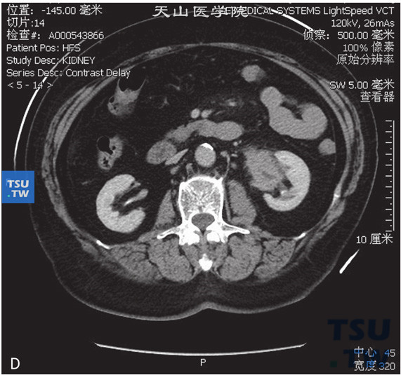 图D：CT，肾炎性假瘤，女，69岁，血尿伴左腰痛。左肾窦内见软组织密度占位，包绕肾盂及肾盂输尿管结合部，外缘毛糙，增强后明显强化。分泌期可见肾盂、肾盏显影，未见明显扩张积水征象