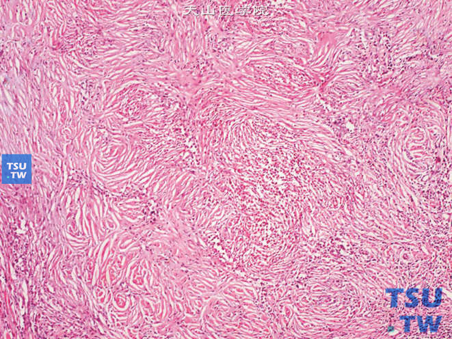 肾炎性假瘤，纤维组织中可见炎细胞浸润